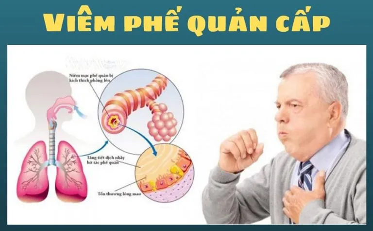 Viêm phế quản cấp: Nguyên nhân, triệu chứng và cách cải thiện bệnh